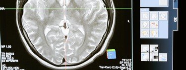 Tenemos una nueva arma contra la pérdida de memoria: un "disco duro" externo en forma de prótesis cerebral